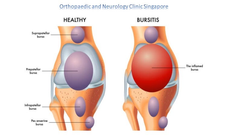Knee Bursitis Main
