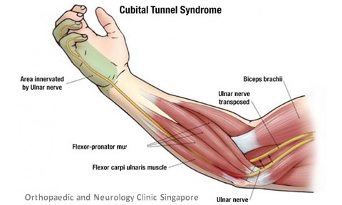 Cubital Tunnel Syndrome Main