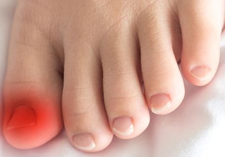 Ingrown Toe Nail Symptom 2
