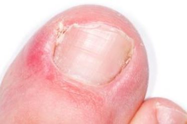 Ingrown Toe Nail Symptom 3