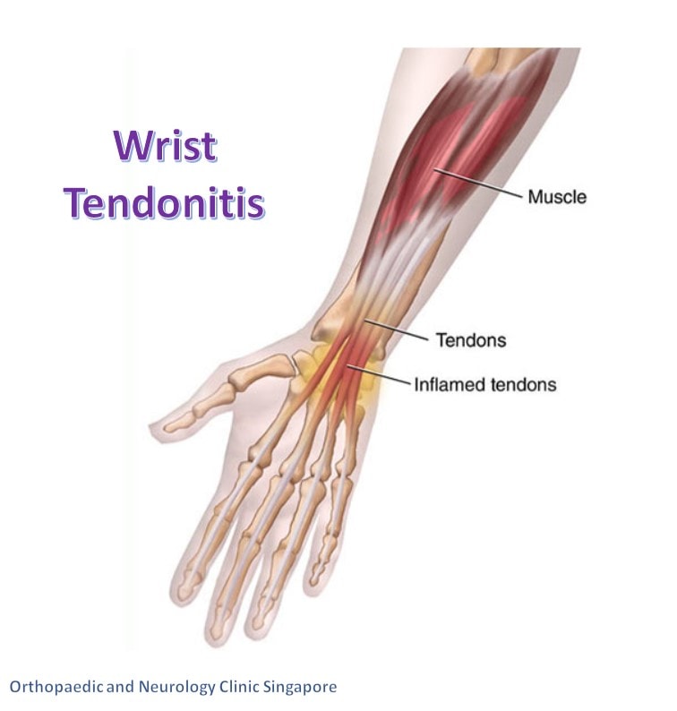 Wrist Tendonitis Main